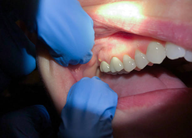 Best Emergency Dental Care for Abscessed Tooth in Buchanan, VA