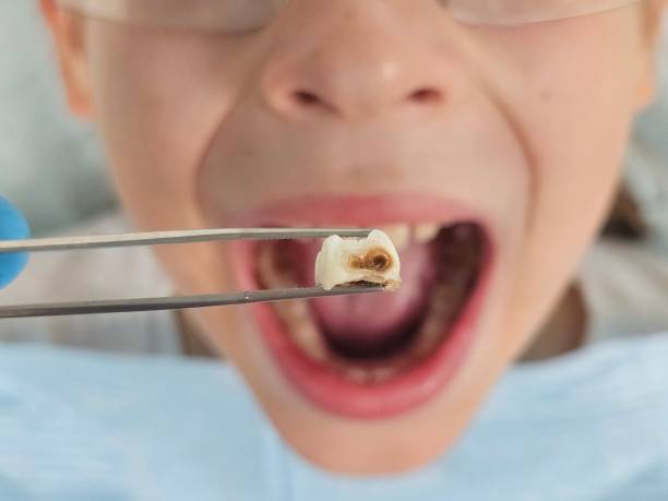 Best Emergency Dentist for Lost Fillings or Crowns in Buchanan, VA